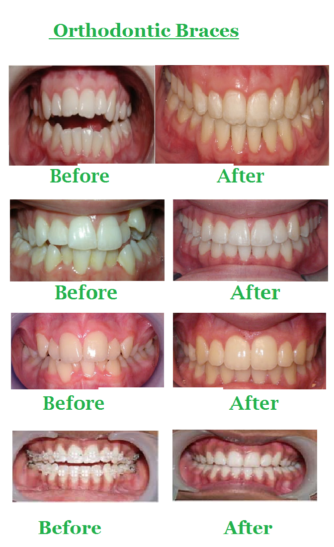 Orthodontic Braces