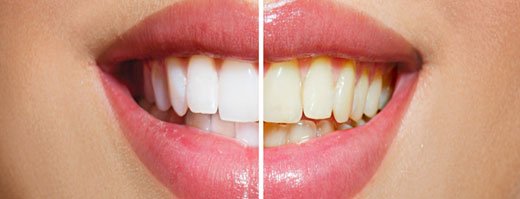 Teeth Whitening