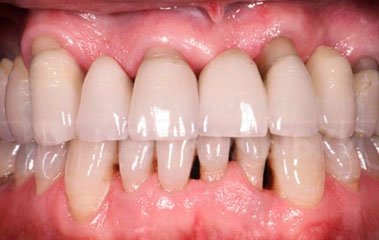 Periodontitis